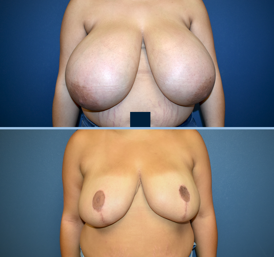 Breast Reduction Patient 5 Front View