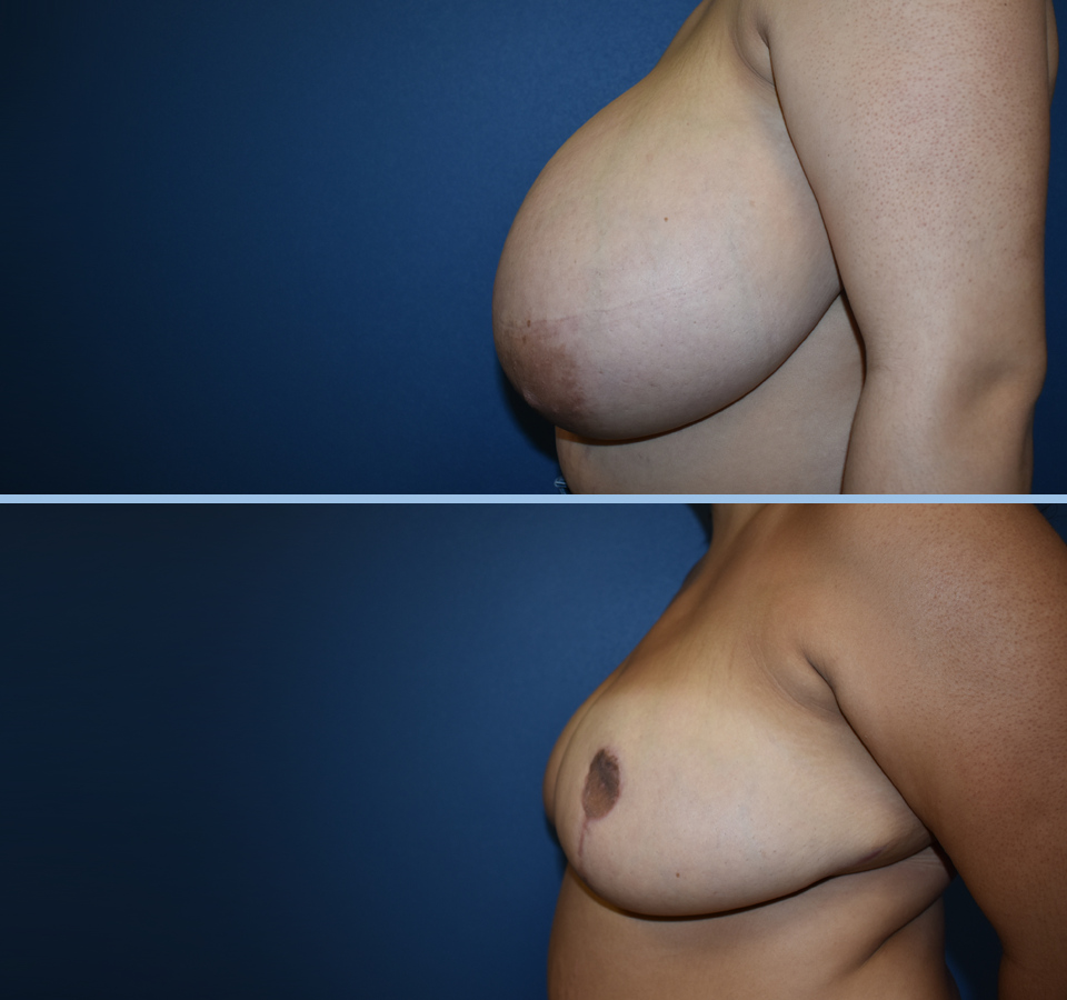 Breast Reduction Patient 5 Left View