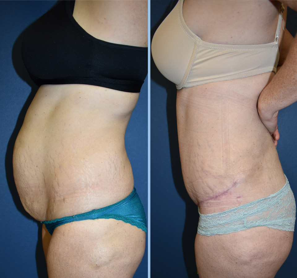 Tummy Tuck Patient 3 Left View