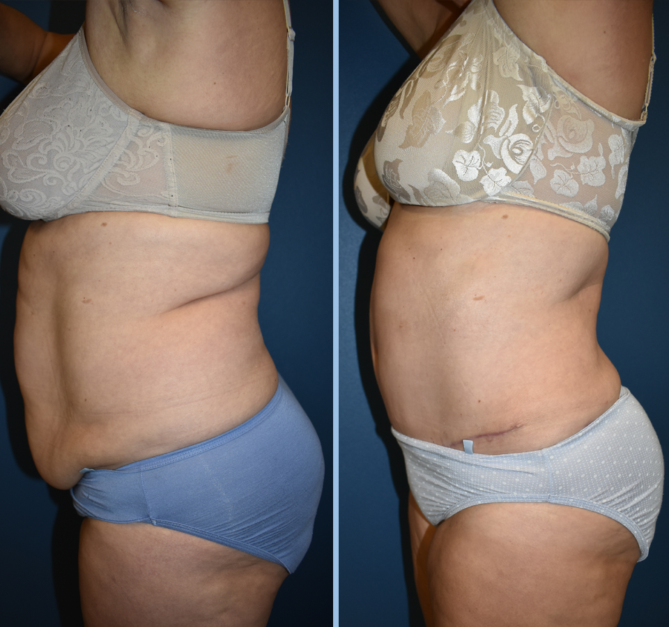 Tummy Tuck Patient 1 Left View