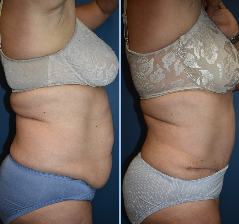 Tummy Tuck Patient 1 Right View