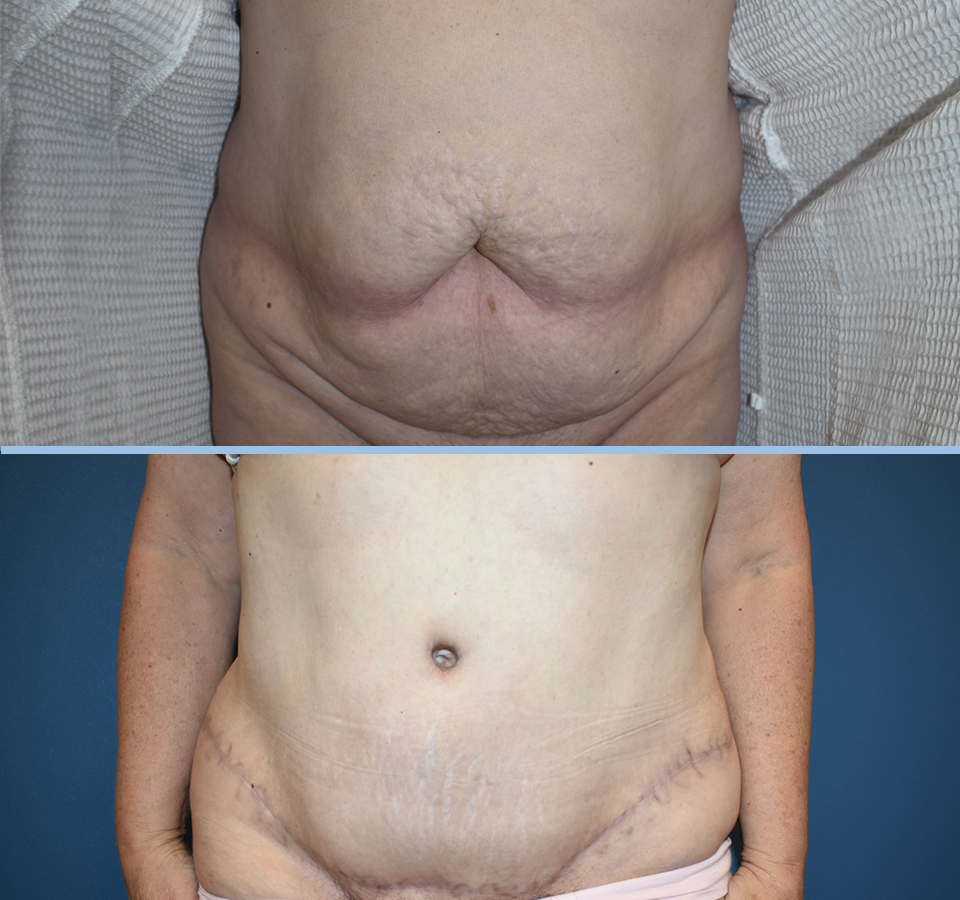 Tummy Tuck Patient 2 Front View