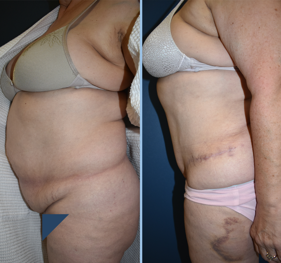 Tummy Tuck Patient 2 Left View