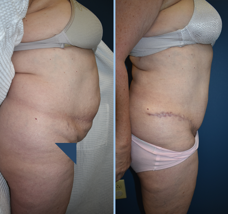 Tummy Tuck Patient 2 Right View