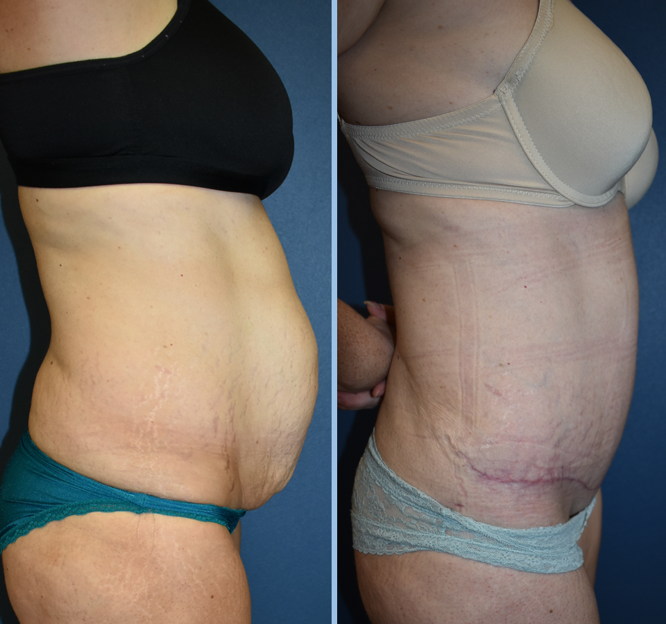 Tummy Tuck Patient 3 Right View