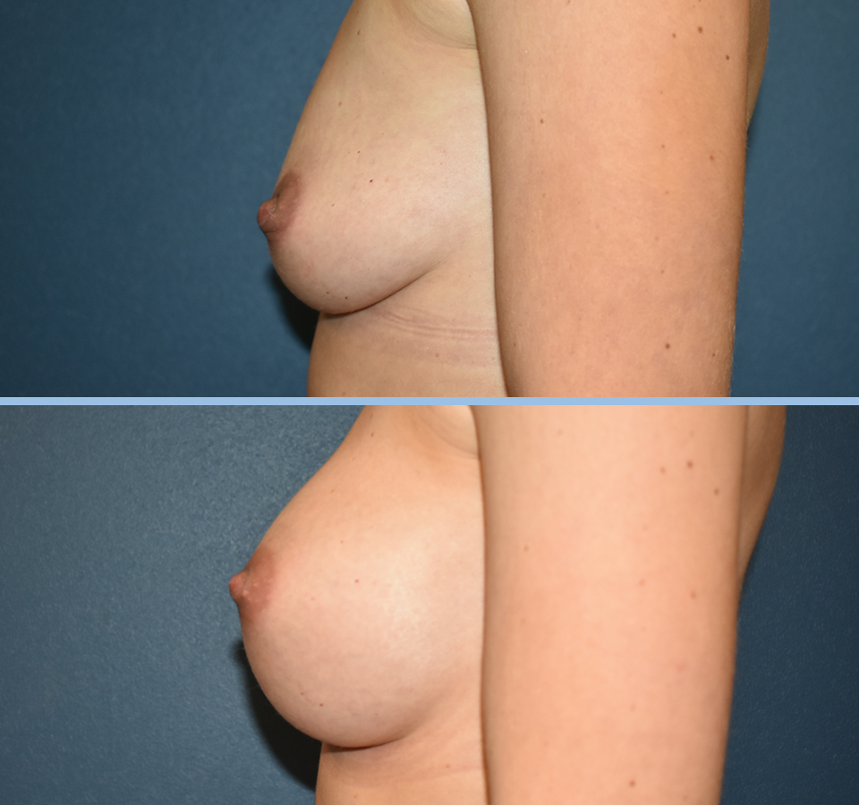 Breast Augmentation Patient 5 Left View
