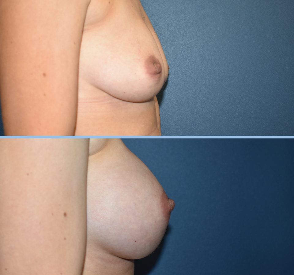 Breast Augmentation Patient 5 Left View
